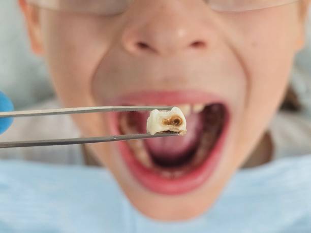 Best Same-Day Emergency Dentist in Chilhowie, VA
